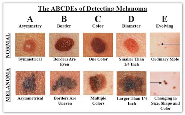 Melanoma Survivors Explain Why Early Detection And Sun 