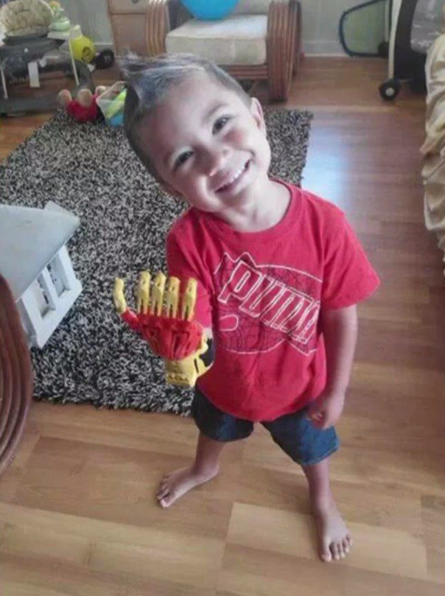 boy gets prosthetic created by 3D printer