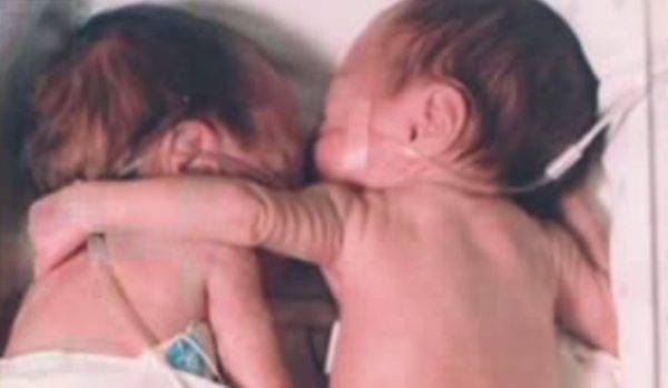 Premature Twins Hug Helped Change Medicine