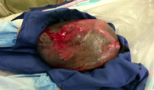 en-caul birth
