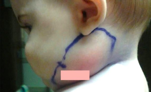 Parents Dumbfounded When Doctors Pull A Feather Protruding From Their Baby’s Neck