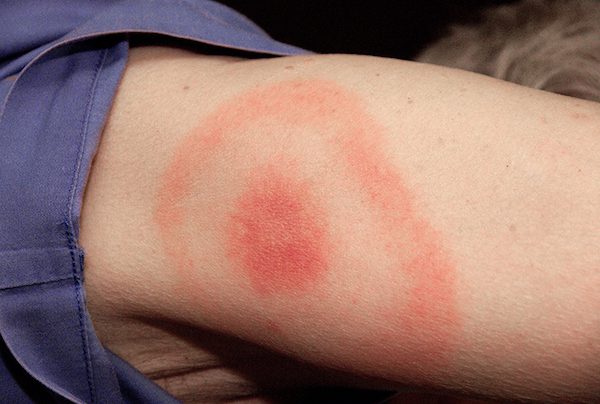Signs Of Lyme Disease Everyone Should Know