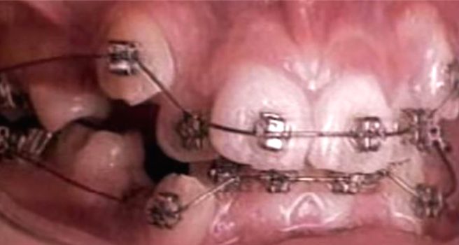 60 Second Timelapse Shows What Happens When You Wear Braces
