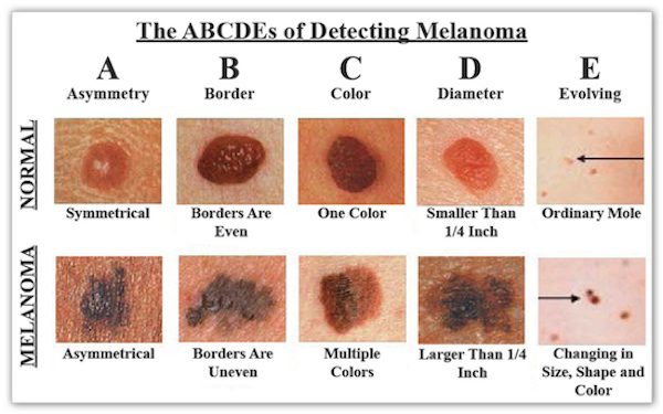 Melanoma Survivors Explain Why Early Detection And Sun Safety Are So