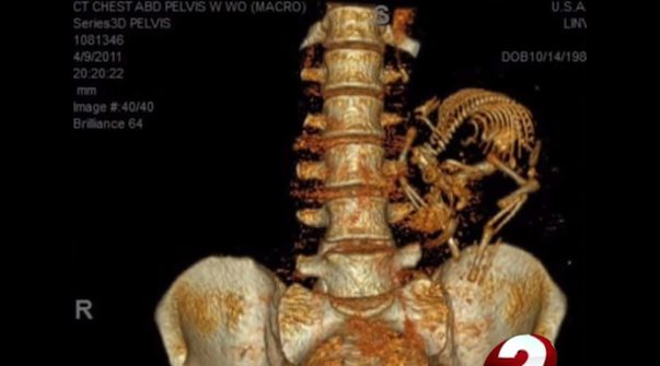 Victim Of Deadly Car Crash Caused By Texting Shares Her Story And Heartbreaking X-Ray