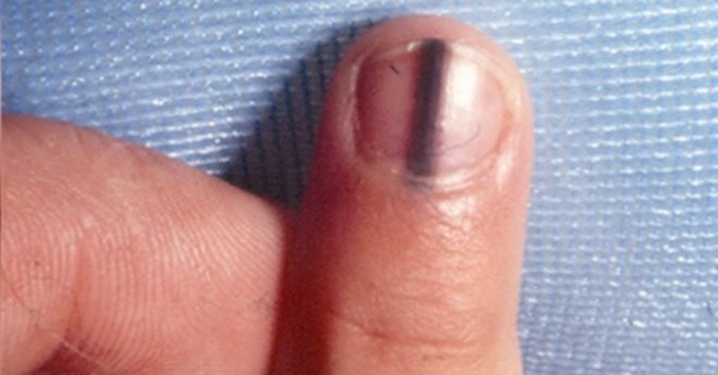 stripe on nail