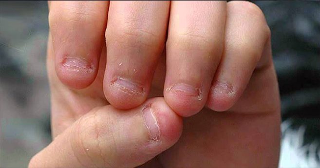 9 Reasons Why You Should Not Bite Your Nails