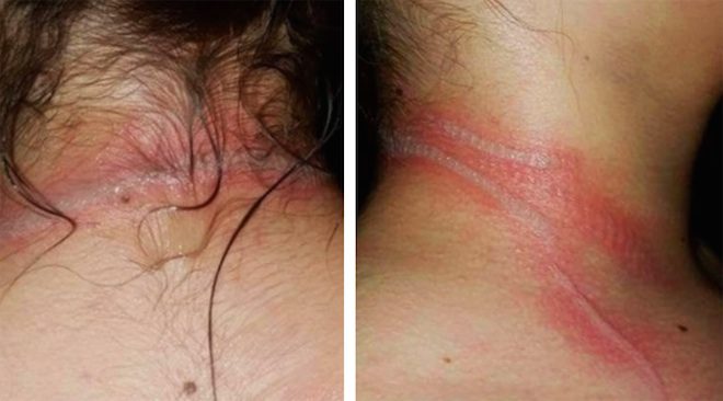 Mom Says Daughter’s Smart Phone Caused Second Degree Burn Around Girl’s Neck