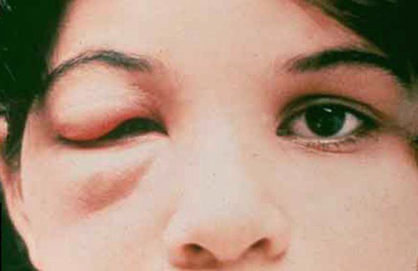 chagas-symptom