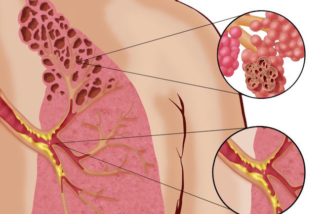 Harvard Study Links E-cigarettes To Incurable Lung Disease Called “Popcorn Lung”