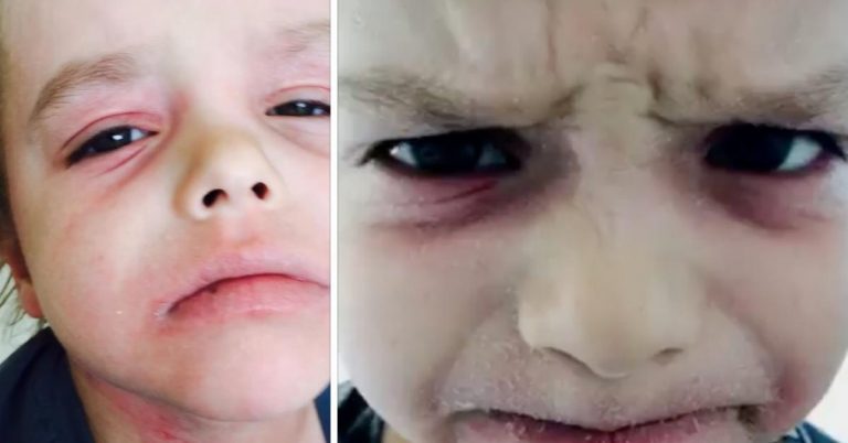 Boy Who Had Suffered Severe Eczema For Years Now Dances For Joy