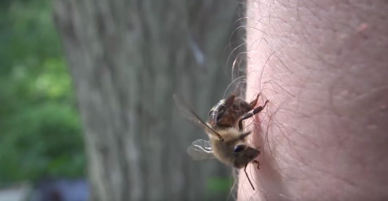 bee sting